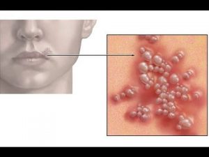 Ako sa zbaviť herpesu herpes na pere