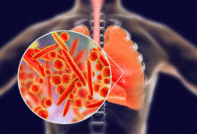 Ako sa prejavuje zápal pľúc