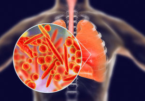 Jak objawia się zapalenie płuc