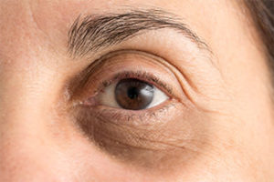 Tiene hinchazón persistente alrededor de los ojos - Síntomas de riñones que funcionan mal