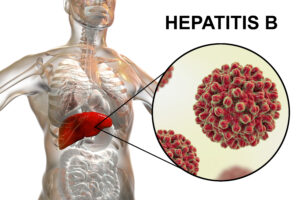 Hepatitída B