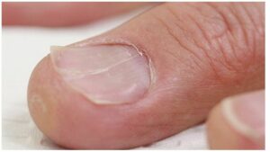 Nagellack och nagellacksborttagningsmedel - Varför naglar bryts